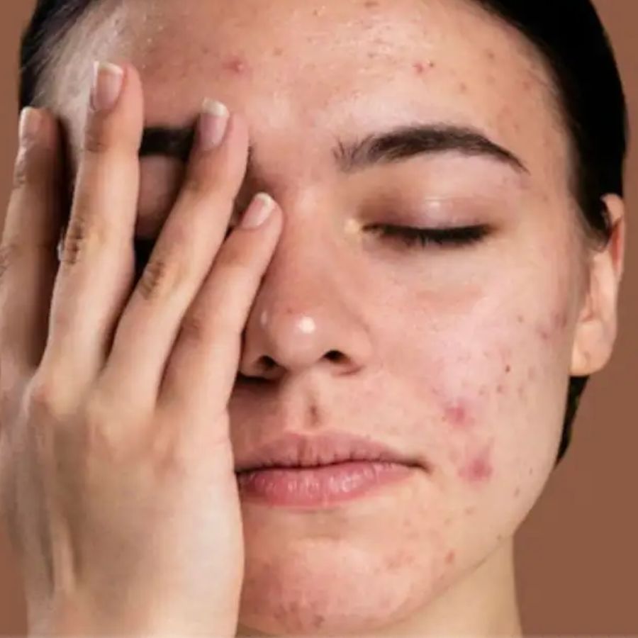 এর ফলস্বরূপ সুন্দর, মসৃণ ত্বক ক্রমে হারিয়ে ফেলে তার নিজস্ব চমক। দোসর হয় ব্রণ, কালো দাগের মতো সমস্যা। 