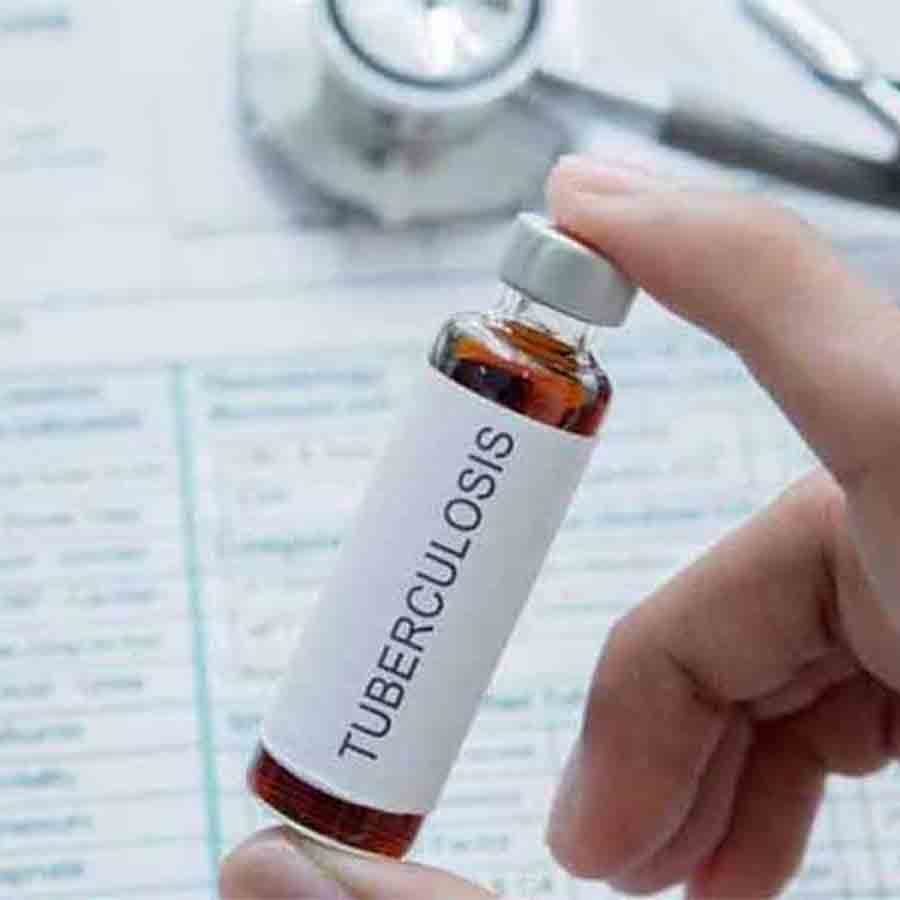 No proper equipment at Rampurhat Medical College to test tuberculosis