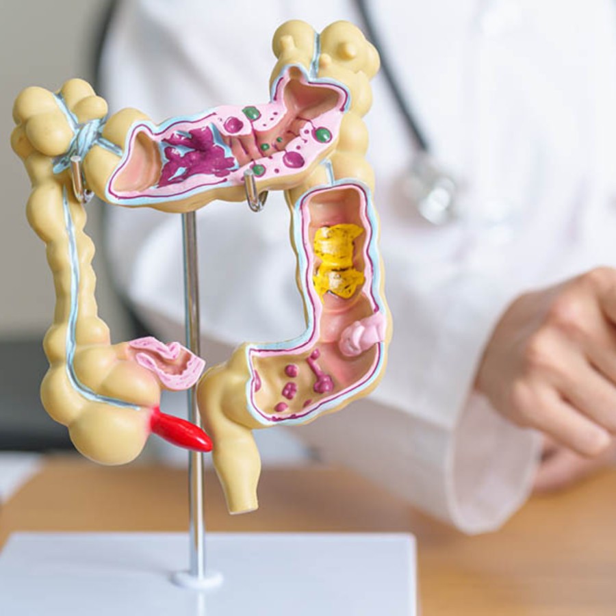 Is it possible to detect colon cancer before showing symptoms, explained by oncologist dgtl