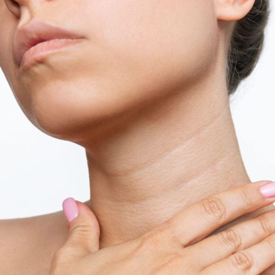 Some home remedy pack to reduce neck wrinkle dgtl