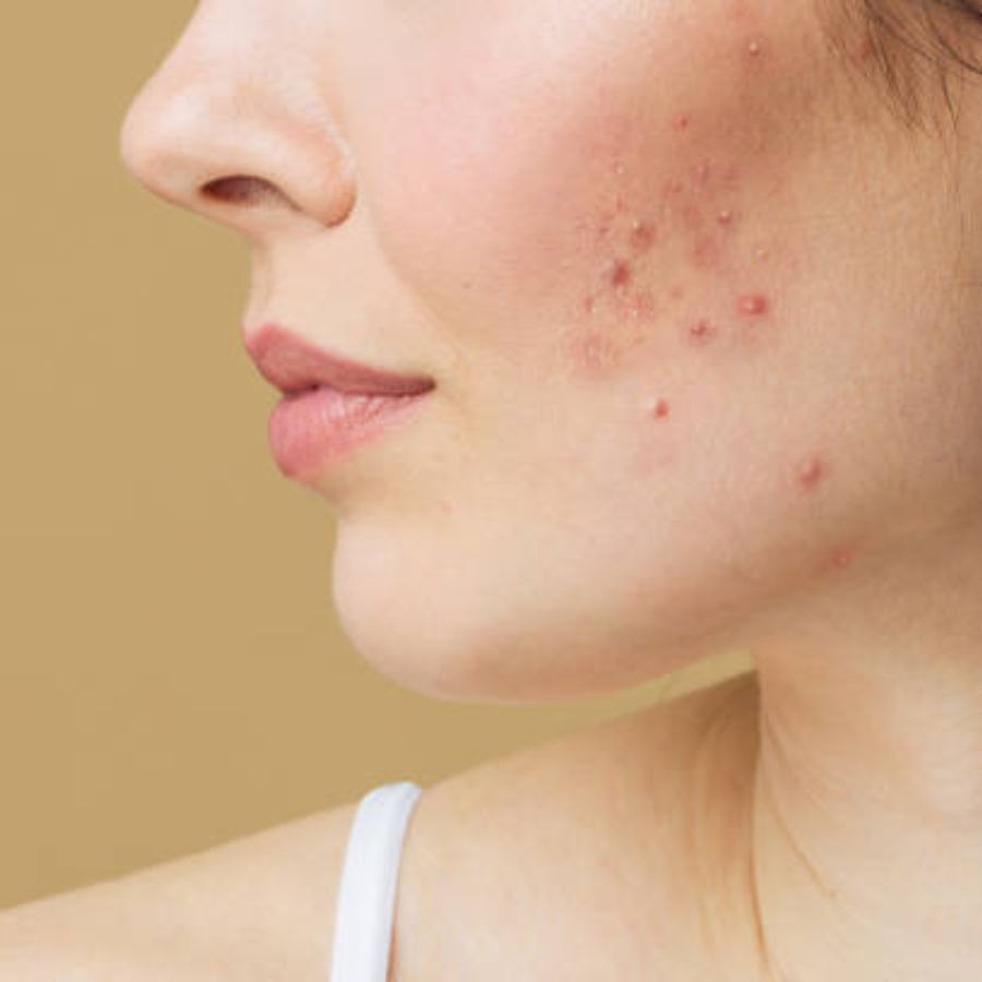 Five reasons you should know about that cause acne dgtl