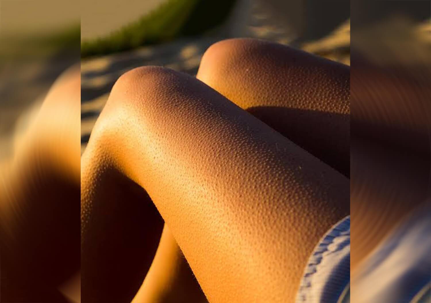 আমাদের অনেকেরই হাতে বা পায়ে ছোট ছোট কালো বা লাল ছোপ দেখা যায়, যা দেখতে অনেকটা স্ট্রবেরির বীজের মতো। এই সমস্যাকে ‘স্ট্রবেরি লেগস’ বা ‘স্ট্রবেরি হ্যান্ডস’ বলা হয়। এটি কেন হয় এবং কী ভাবে এর মোকাবিলা করা যায়, জেনে নিন।