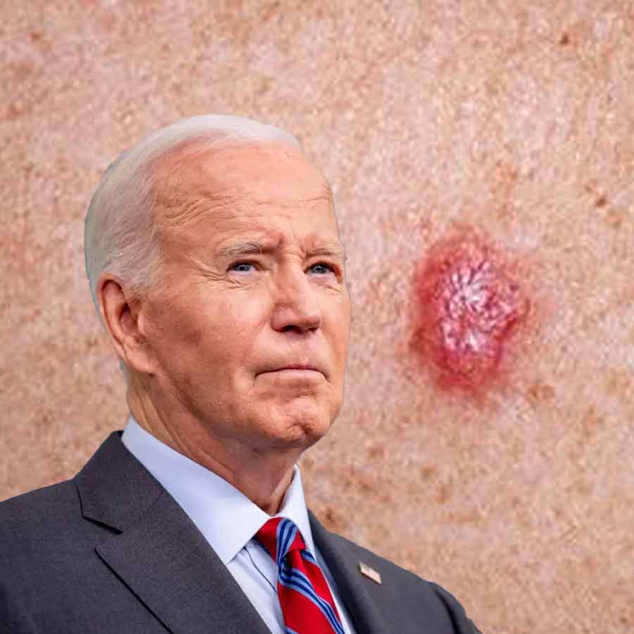 Joe Biden underwent surgery to remove cancerous cells from his skin, what are symptoms of Skin Cancer
