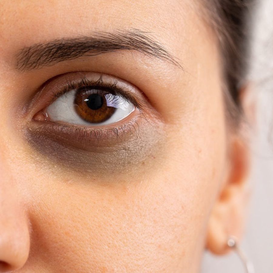 How to remove dark circles at home naturally Before Durga Puja dgtl