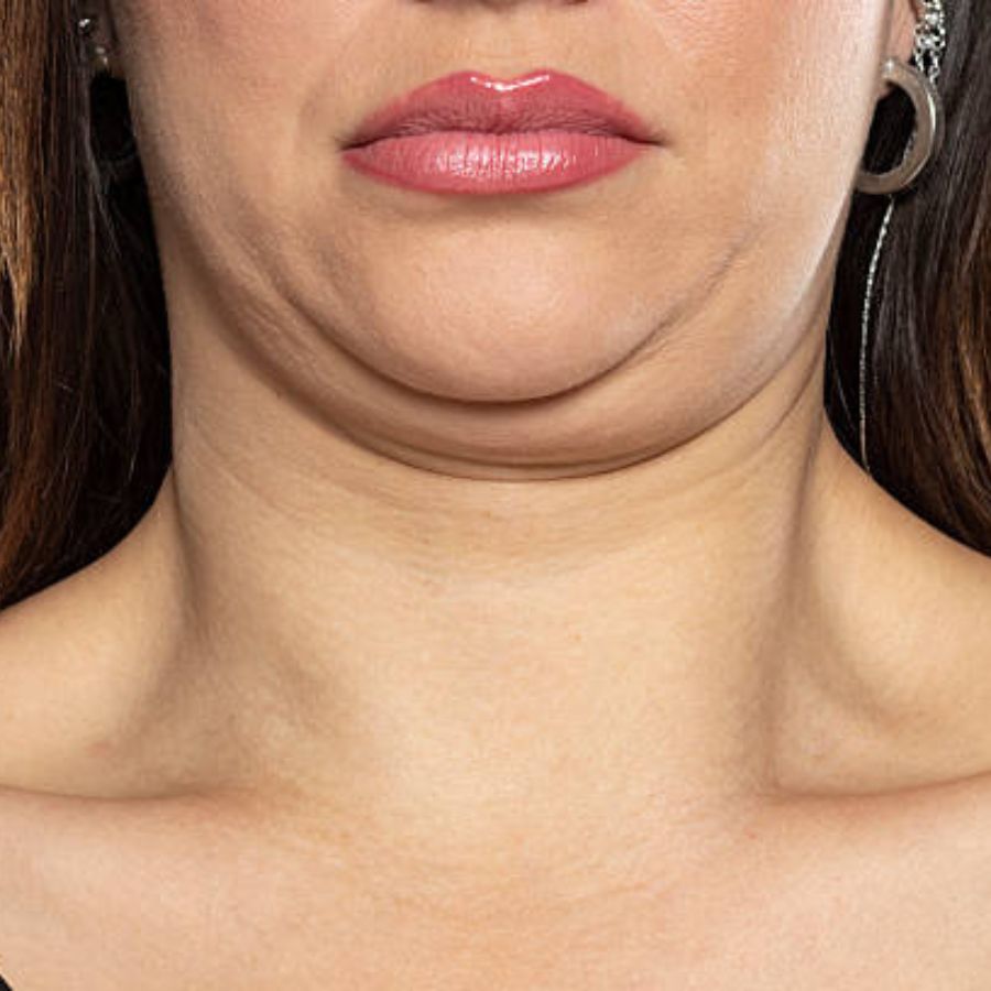 How to reduce or remove double chin ahead of durga puja dgtl