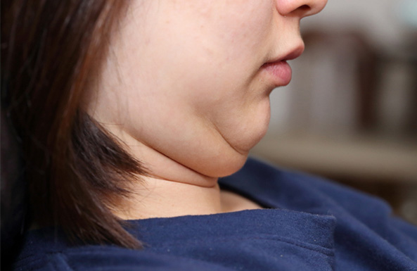 বংশগত কারণ:   পরিবারে কারও যদি ডবল চিনের সমস্যা থাকে, তা হলে আপনার এটি হওয়ার আশঙ্কা বেশি। এটি জিনগত বৈশিষ্ট্য হতে পারে। যদি আপনার পরিবারে এই ধরনের সমস্যা থাকে, তা হলে অল্প বয়স থেকেই জীবনযাত্রার মানের দিকে নজর রাখা জরুরি।