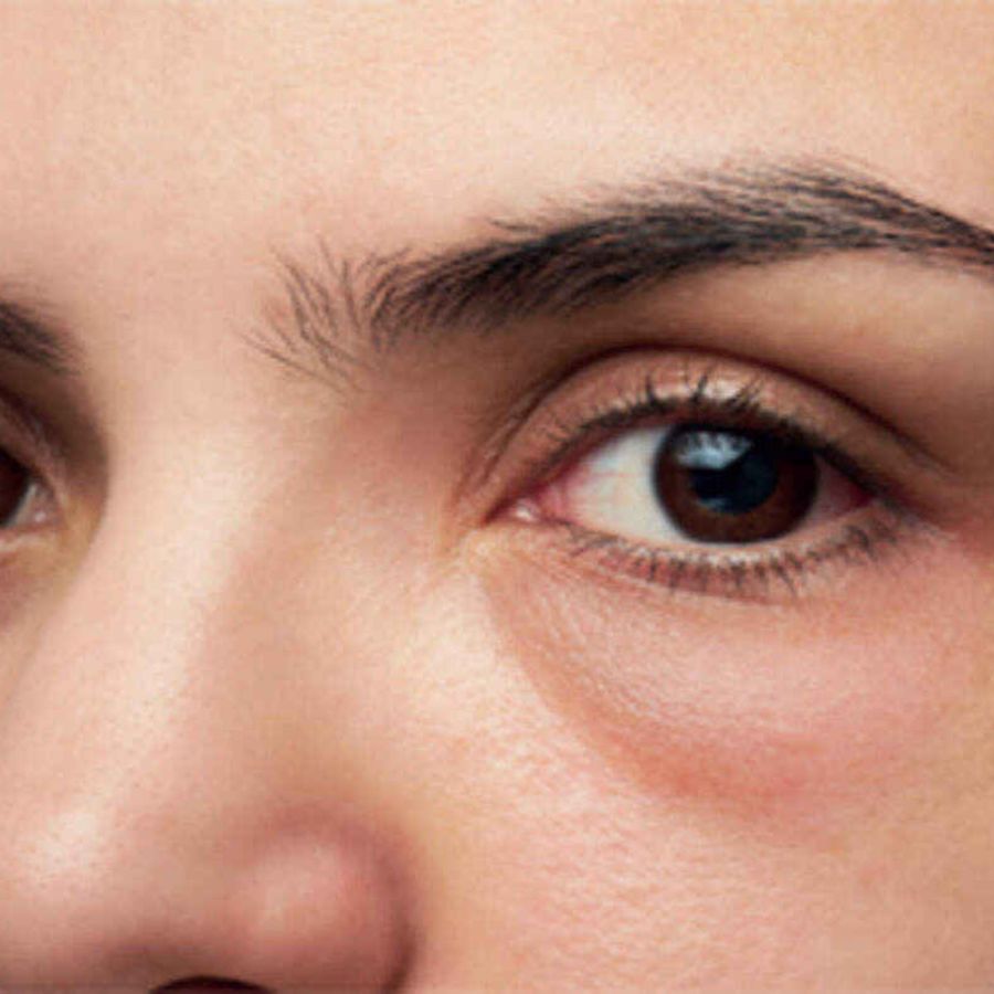 Home remedies to get rid of under eye puffiness dgtl