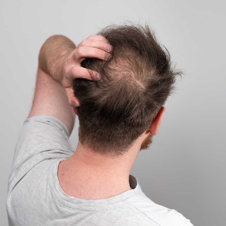 Five lifestyle changes you need to make to prevent hair loss problem dgtl