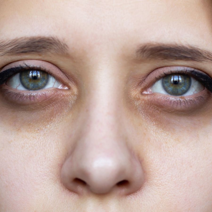 How to remove dark circles at home naturally Before Durga Puja dgtl