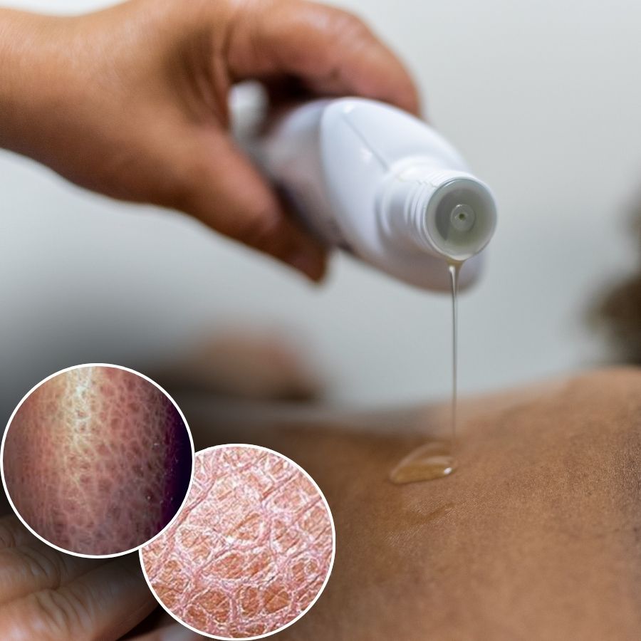 How to Get Rid of Dry Flaky Skin Like Fish Scales to Restore Glow before puja dgtl