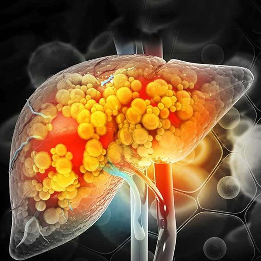 Scientists unveil a potential first of its kind treatment for fatty liver disease