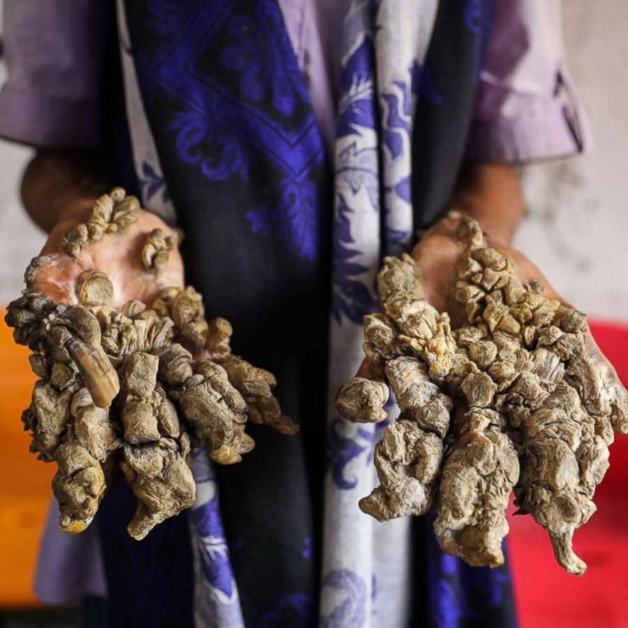 The Rare Genetic disorder causes tree-bark like lesion on skin dgtl