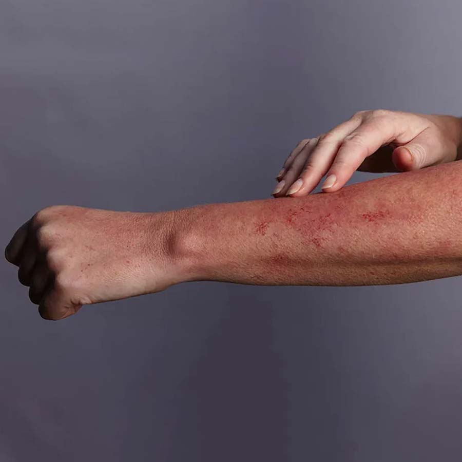 A thief bite a shopkeeper’s arm