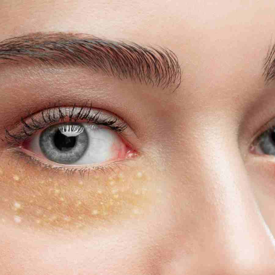 These are the Safe Ways to Treat Milia Around The Eyes and Cheeks dgtl