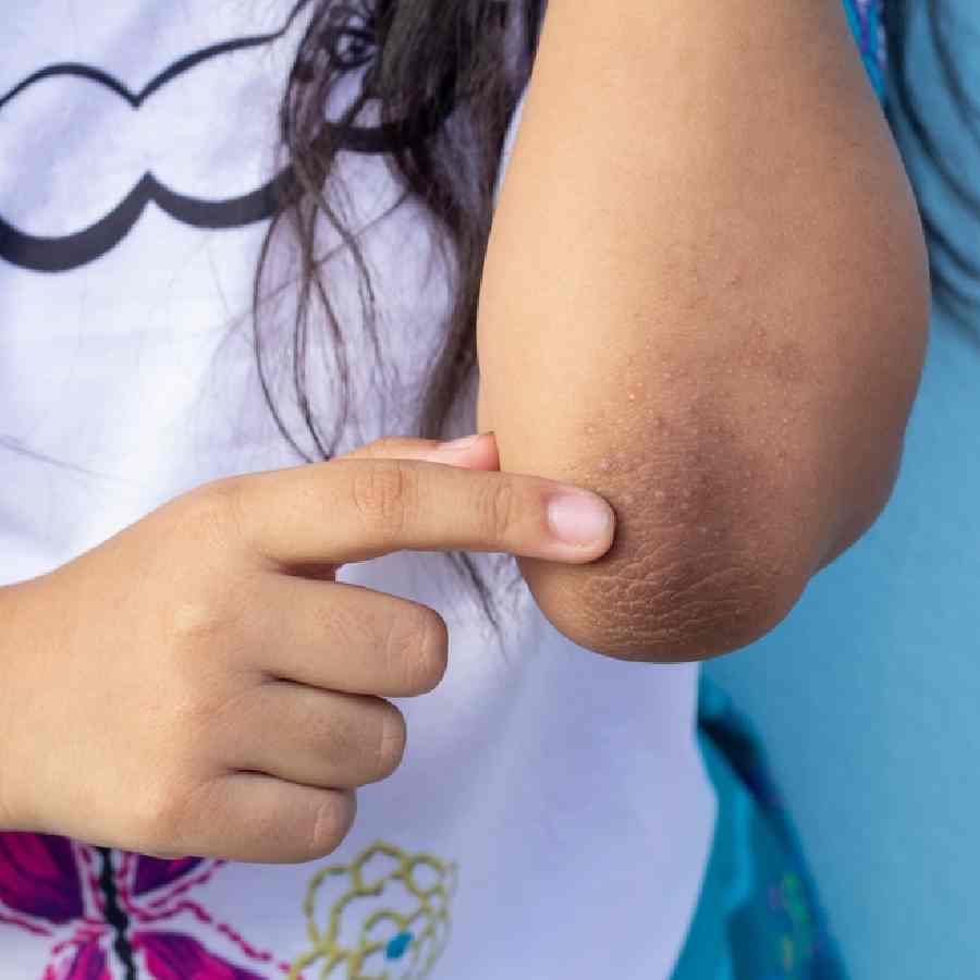 Five home remedies for dark elbows dgtl