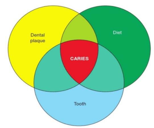 ক্যাভিটি বা কেরিজ়ের সূত্রপাত হয় এমন ভাবেই।
