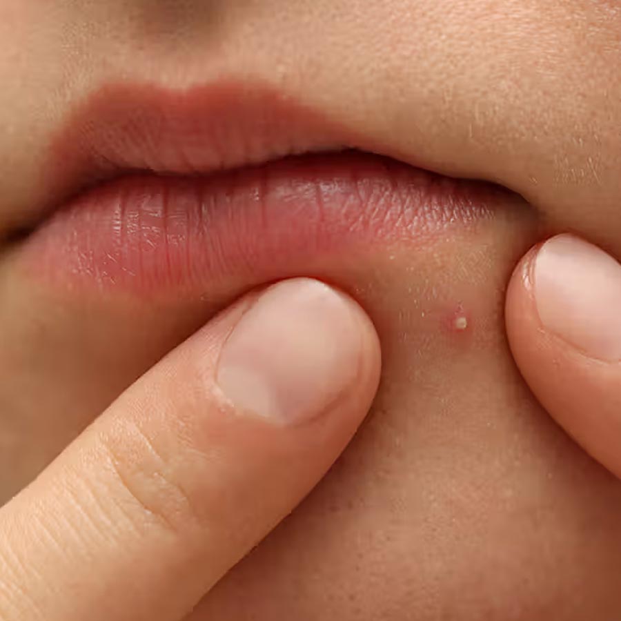 Popping a simple pimple in certain areas of the face can cause paralysis