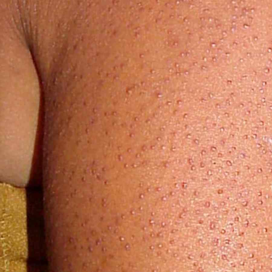 কেরাটোসিস-পিলারিসে সারা ত্বক ভরে যায় ছোট ছোট লালচে-কালো গুটিতে।