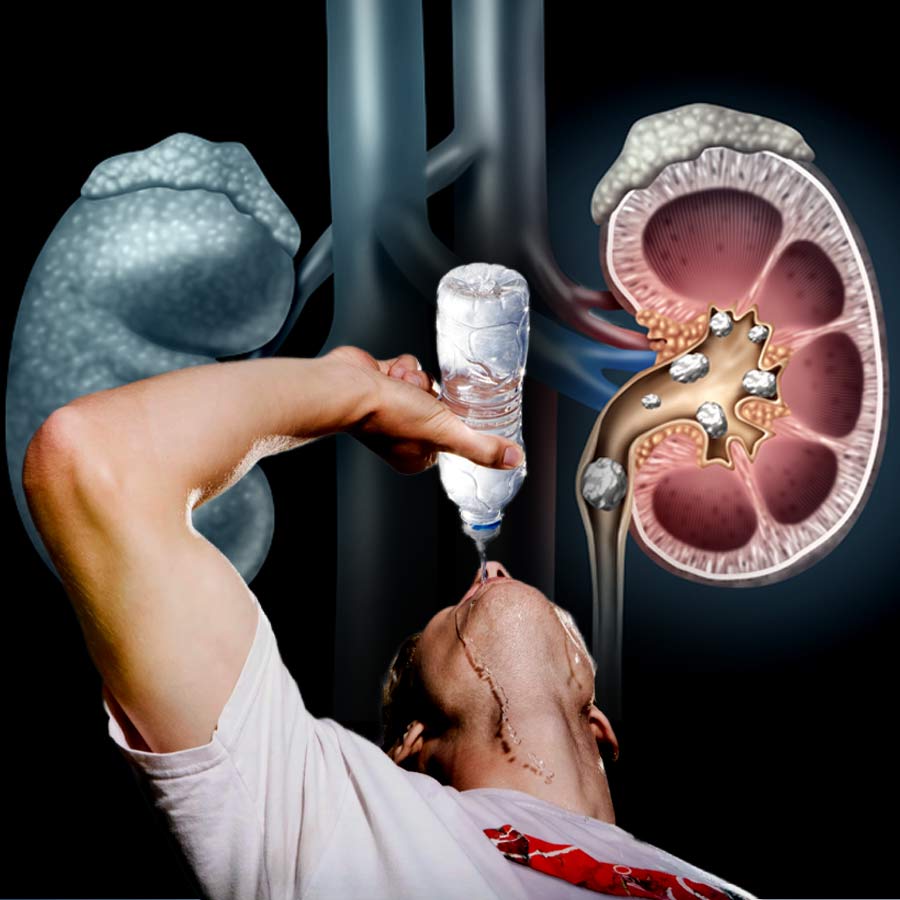 কিডনির পাথর বেরিয়ে যায় বেশি জল খেলে?