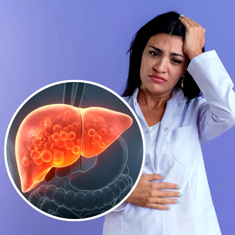 Why Declining Hormones After 45 Accelerate Liver Fat Accumulation in Women