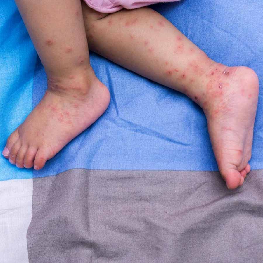 Rubella alert, Keep Your Child Safe during the Seasonal Shift