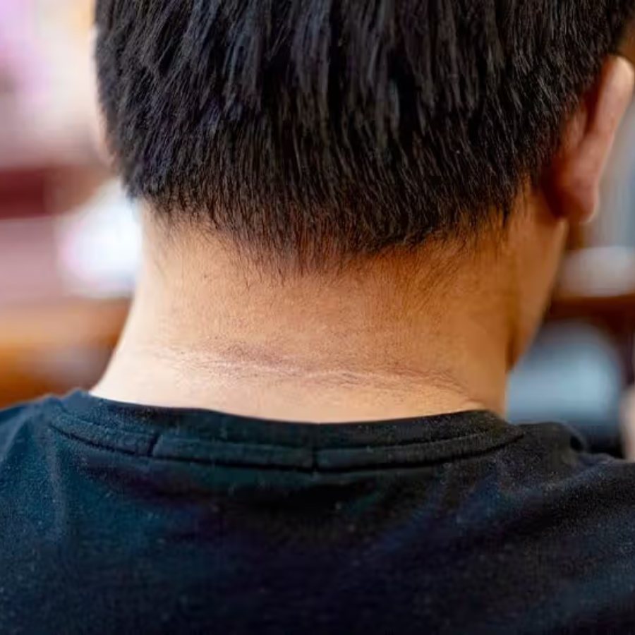 Health risks behind children showing dark patch around neck and underarms dgtl