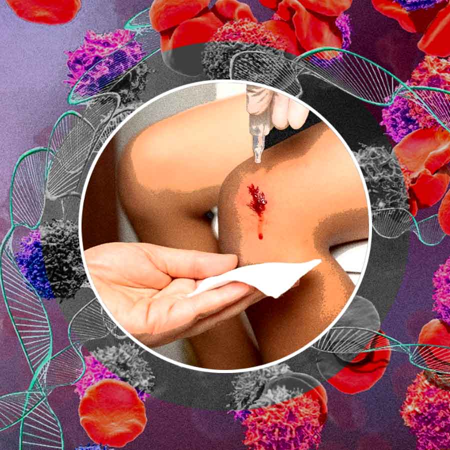 Unstoppable bleeding, recognizing the signs of Hemophilia