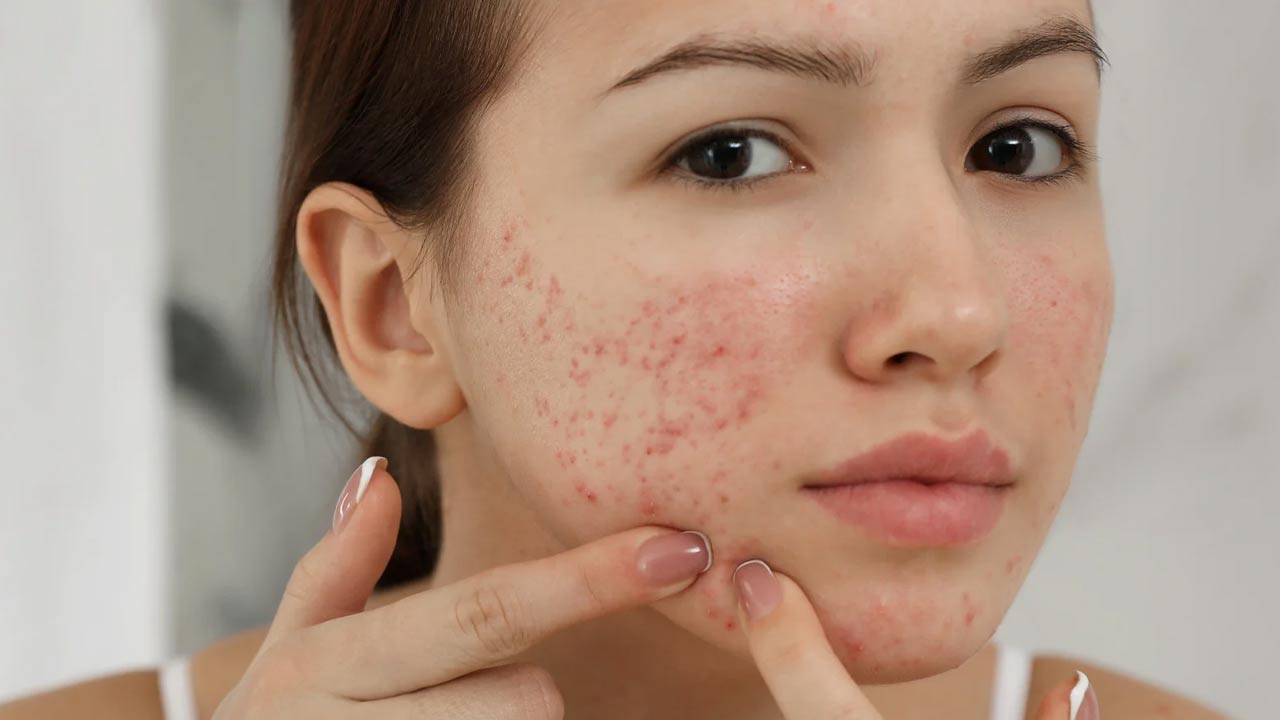 সিস্টিক অ্যাকনের কষ্ট কমবে কী ভাবে?