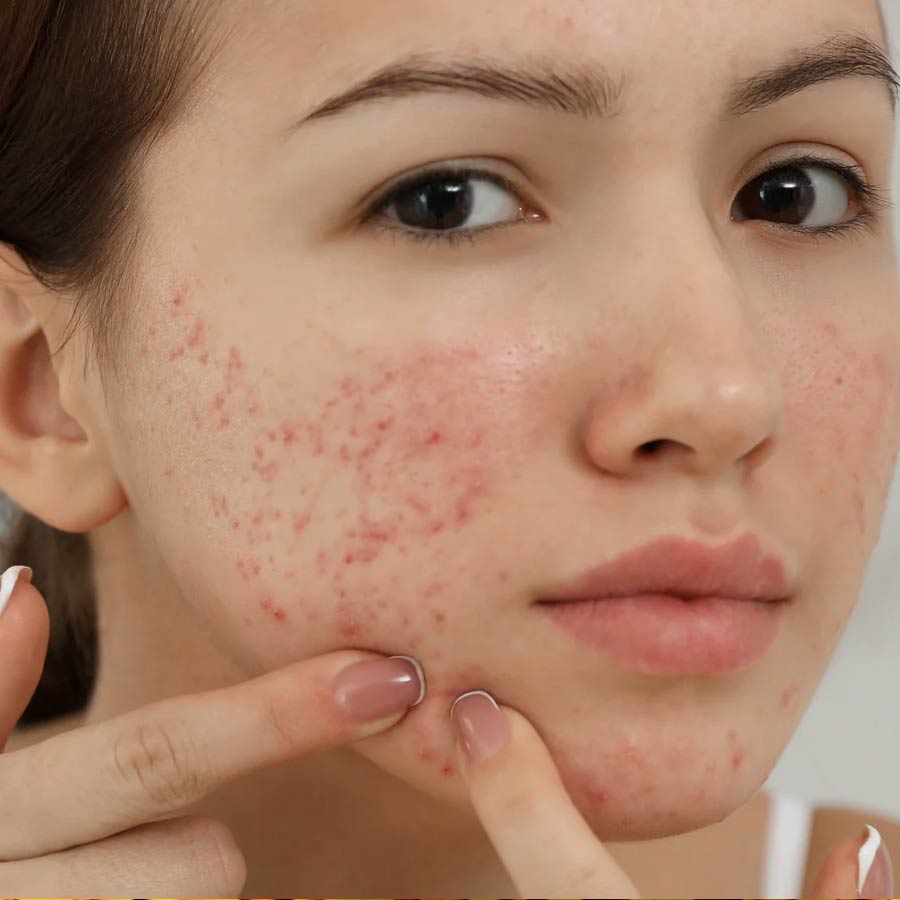 Cystic Acne Survival Guide, Natural Ways to Reduce Swelling and Pain Fast dgtl