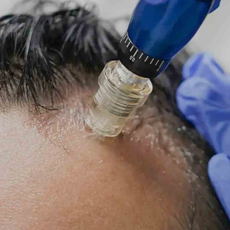 Does Microneedling therapy help with hair loss