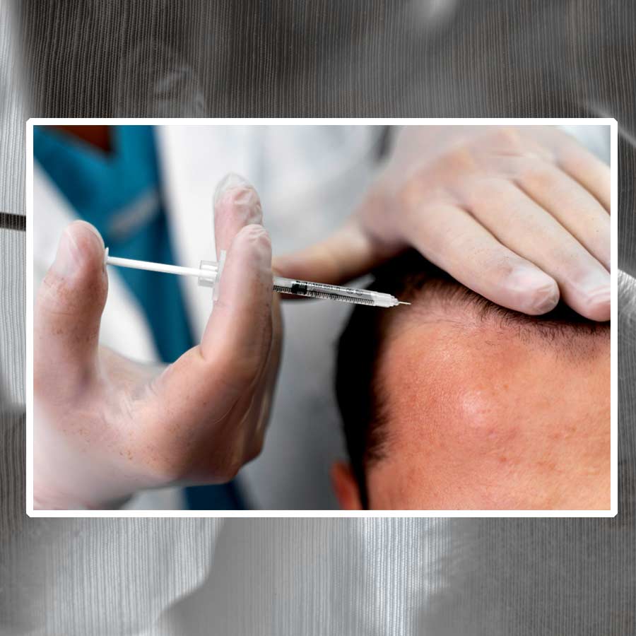 Does Microneedling therapy help with hair loss