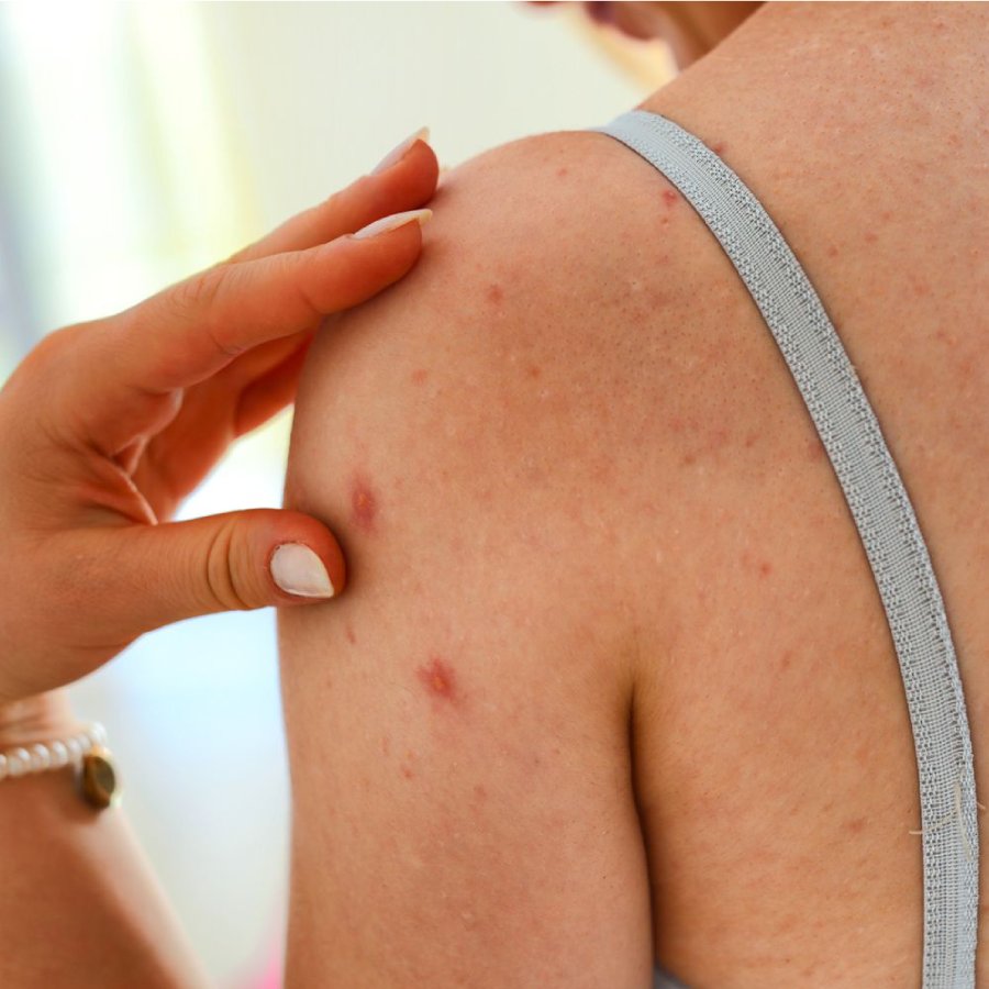 Why does body acne happen and how to prevent it dgtl