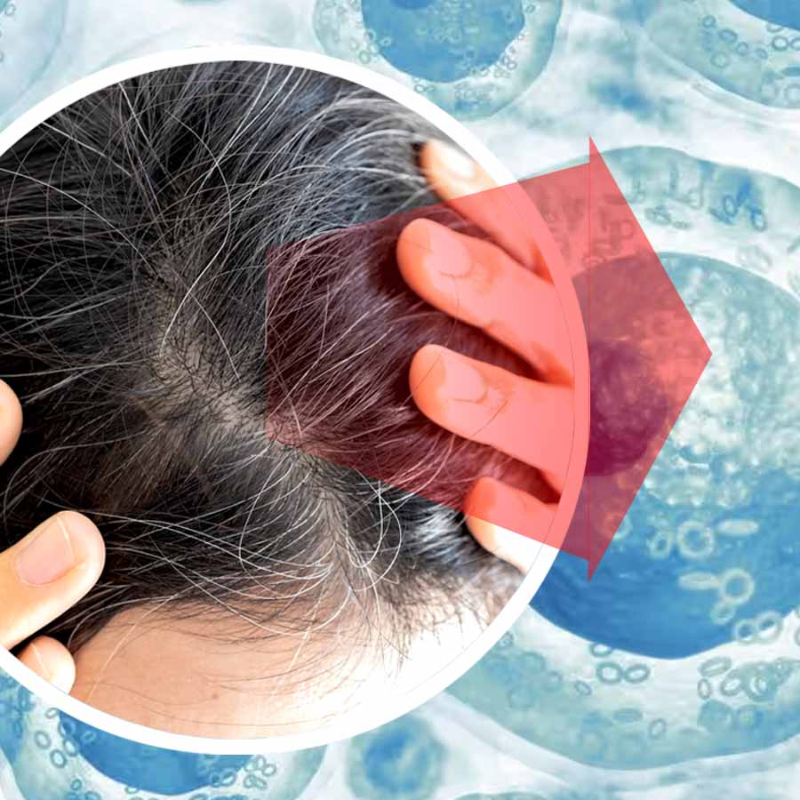 A study links graying hair to stem cells getting stuck, unable to colour new hair growth dgtl
