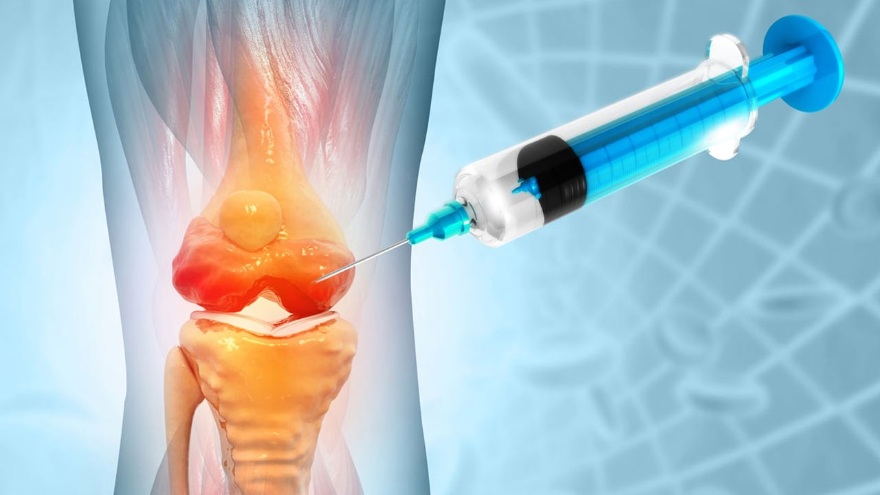 Platelet-Rich Plasma Therapy is An effective treatment procedure managing Knee Osteoarthritis