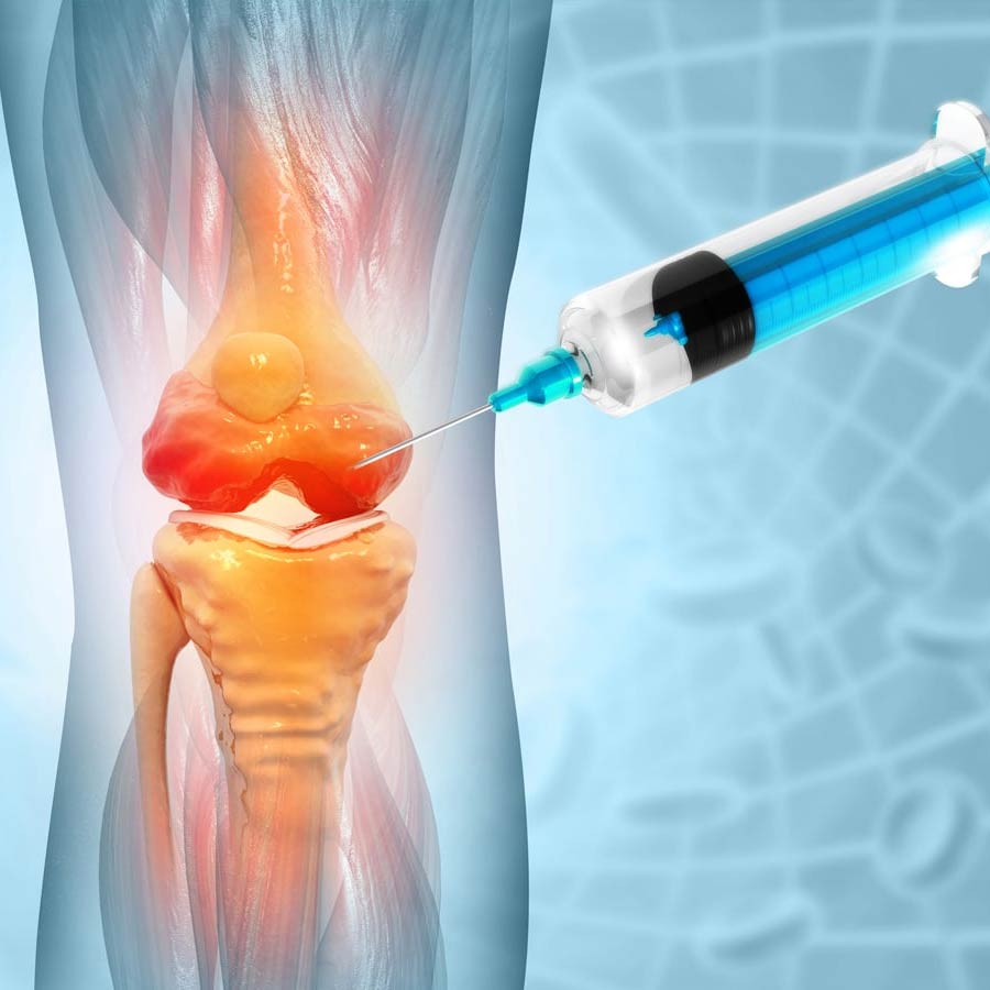 Platelet-Rich Plasma Therapy is An effective treatment procedure managing Knee Osteoarthritis