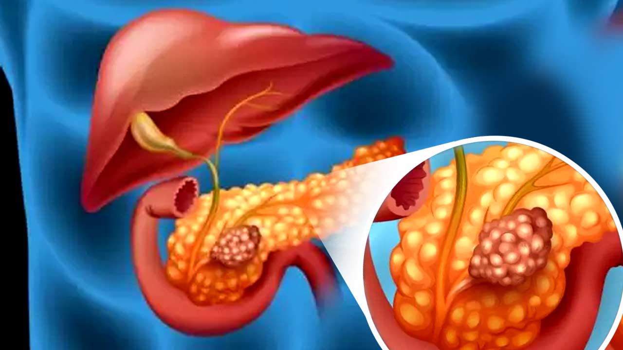 Scientists have created new triple combination therapy that cures pancreatic Cancer in Mice