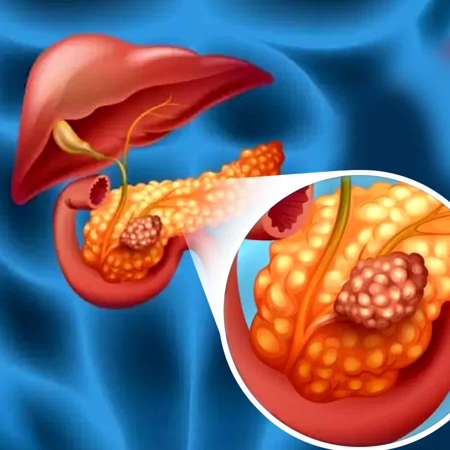 Scientists have created new triple combination therapy that cures pancreatic Cancer in Mice