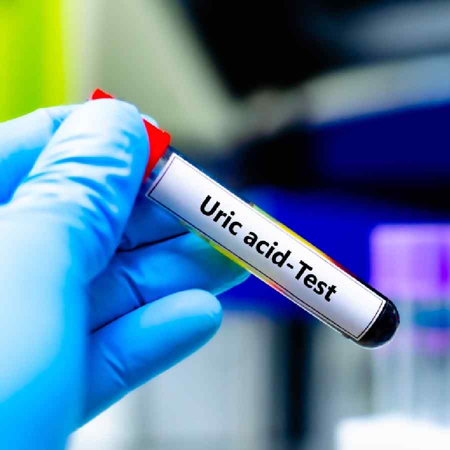 ইউরিক অ্যাসিড কমাতে কী কী করবেন?