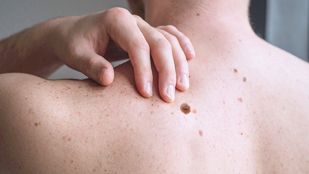 আঁচিলের পরিবর্তনেই ক্যানসারের ইঙ্গিত?