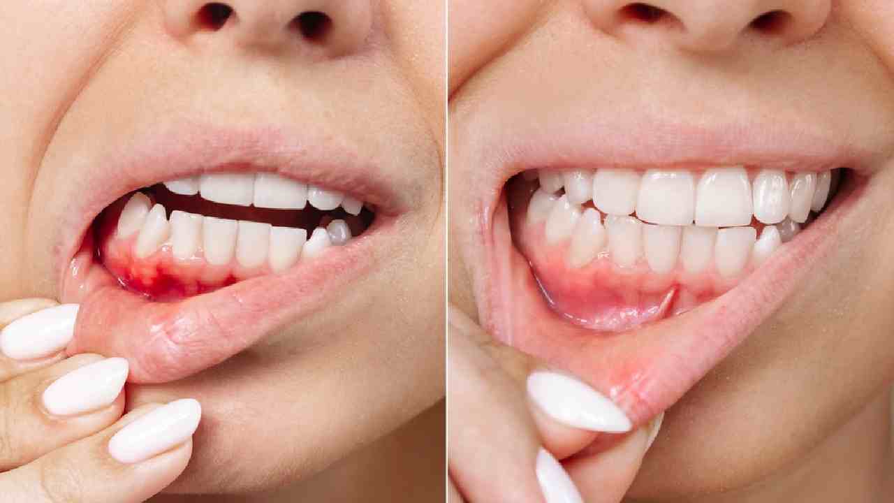 দু’বেলা ব্রাশ করেও মাড়ি থেকে রক্ত বেরোচ্ছে?