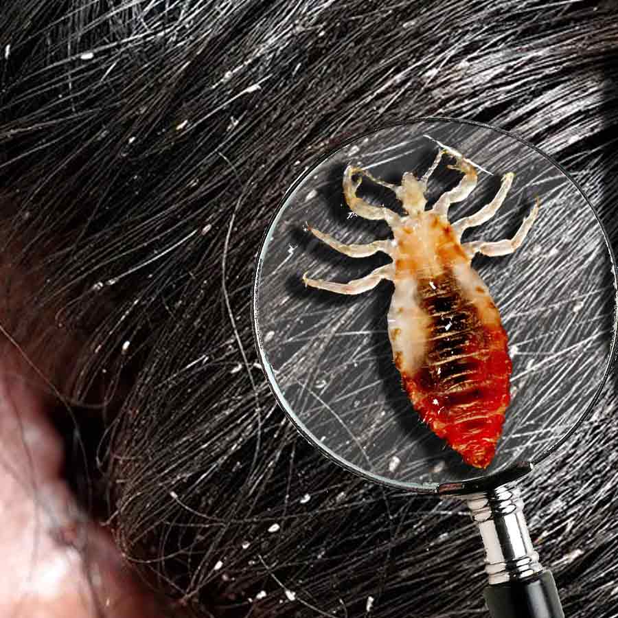 উকুন যখন প্রাণঘাতী।