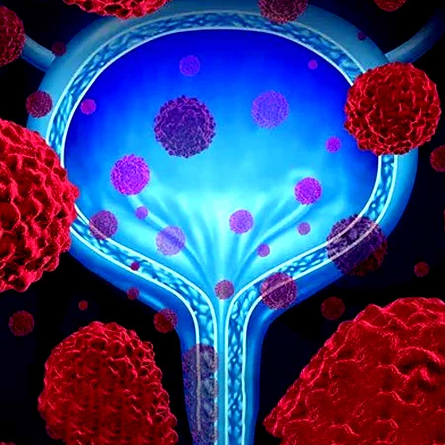 How Urine signals danger and alerts you about urine bladder cancer dgtl