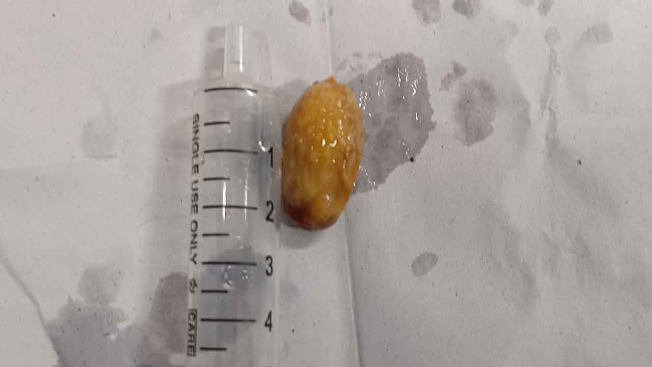 A 13-year-old girl was rescued after a Indian plum seed stuck in her throat Bronchoscopy at NRS Hospital saved her life