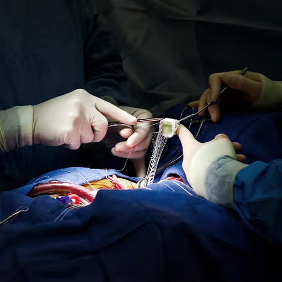 ল্যাপারোস্কোপিকের মাধ্যমে হার্টের অস্ত্রোপচার