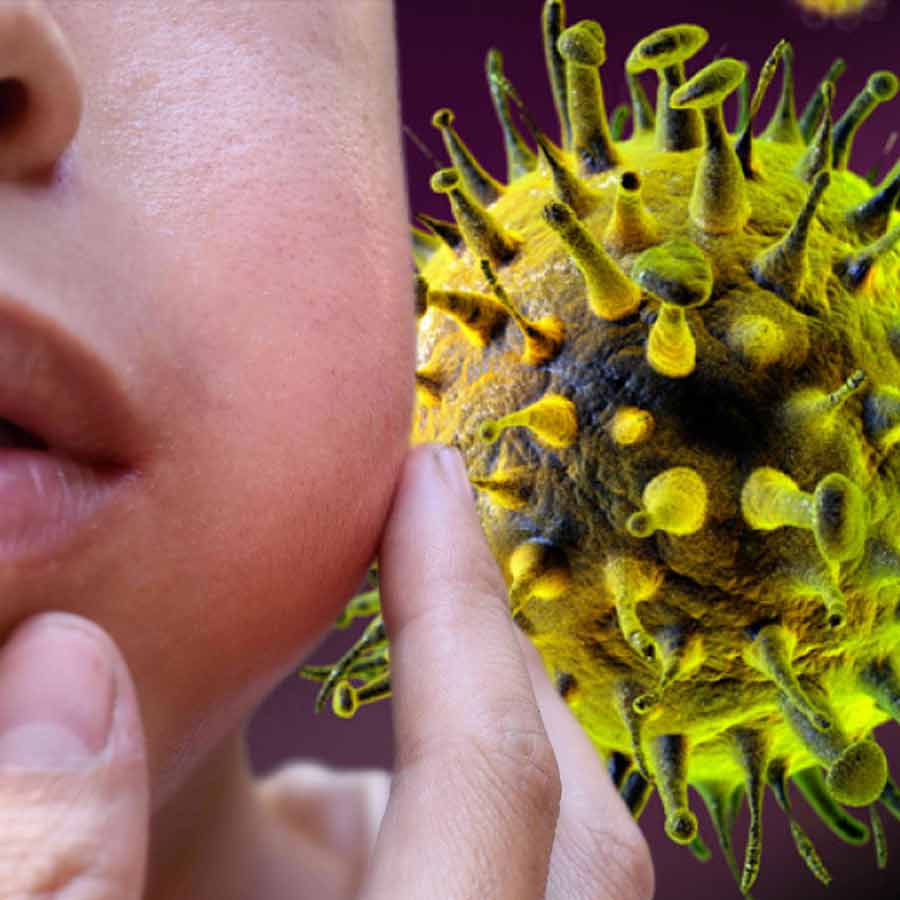 Why Mumps Rises in Spring, what are the symptoms and prevention tips