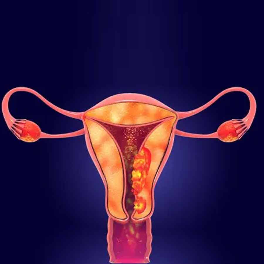 These are the early signs and symptoms of Endometrial Cancer