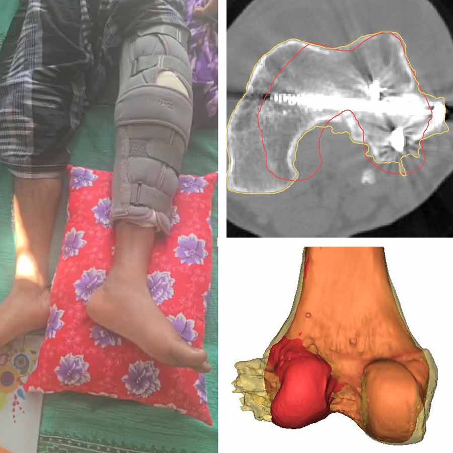 হাড় প্রতিস্থাপন করা হয়েছে রিজাউদ্দিনের পায়ে। নিজস্ব চিত্র।