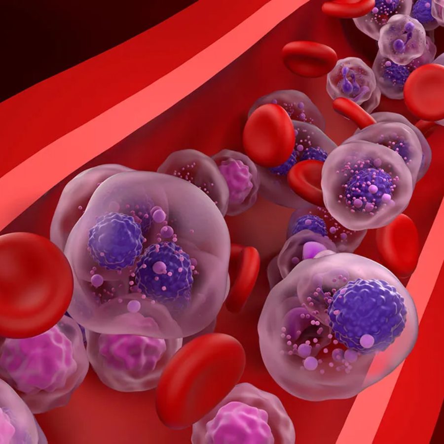 মালটিপ্‌ল মাইলোমার লক্ষণ।