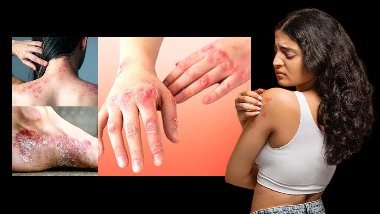 What is Psoriasis, what are the causes, types and treatments