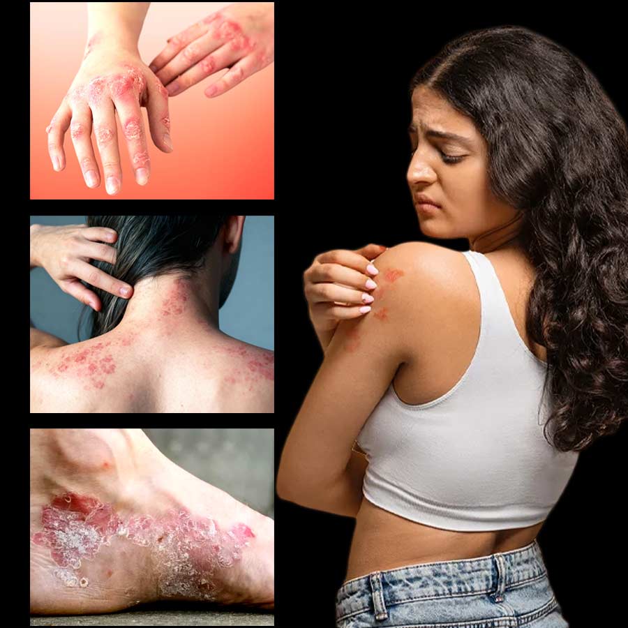 What is Psoriasis, what are the causes, types and treatments